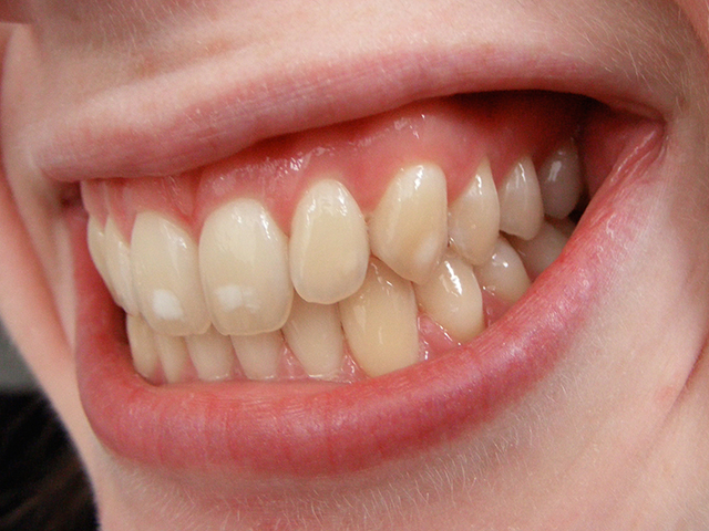 Tooth Colour